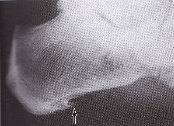 測定筋膜炎の踵骨骨棘のレントゲン