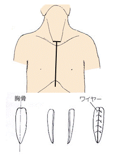 胸骨縦切開術のイラスト