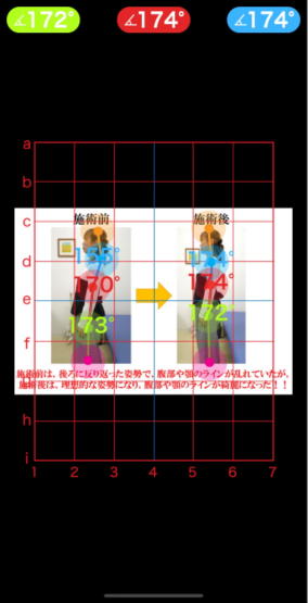 横浜鶴見の整体院「指楽」でブライダル整体を受けた患者様�AAI姿勢分析