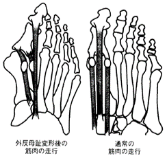 外反母趾の筋肉の写真