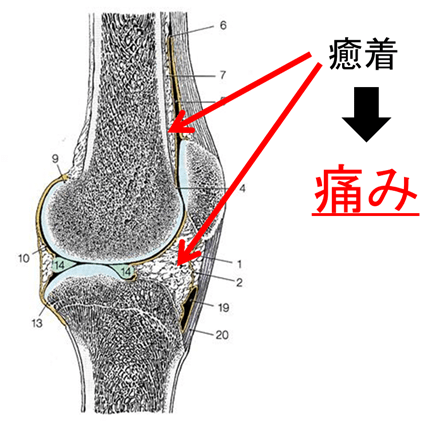 筋肉と骨の癒着が原因の膝の痛みのイラスト