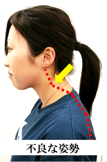 首の痛い方の頸椎の不良姿勢