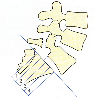 腰椎分離症の図